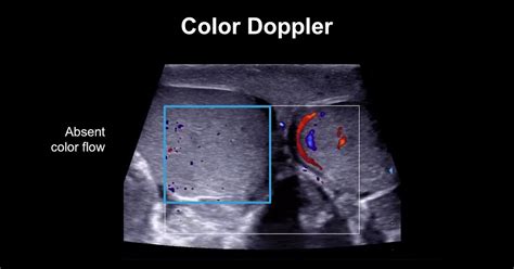 testicular torsion ultrasound test